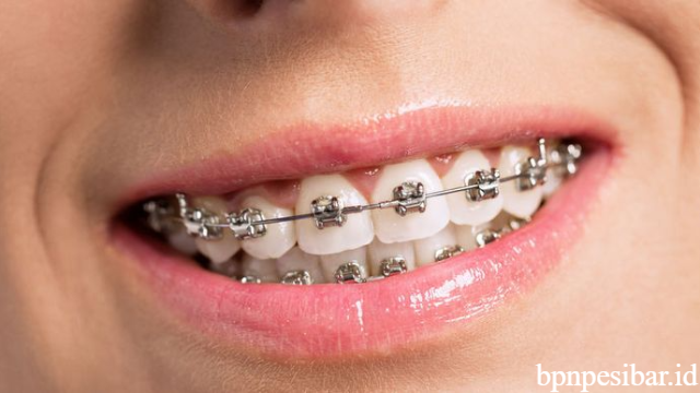 Cara Merawat Kesehatan Gigi untuk Pengguna Behel